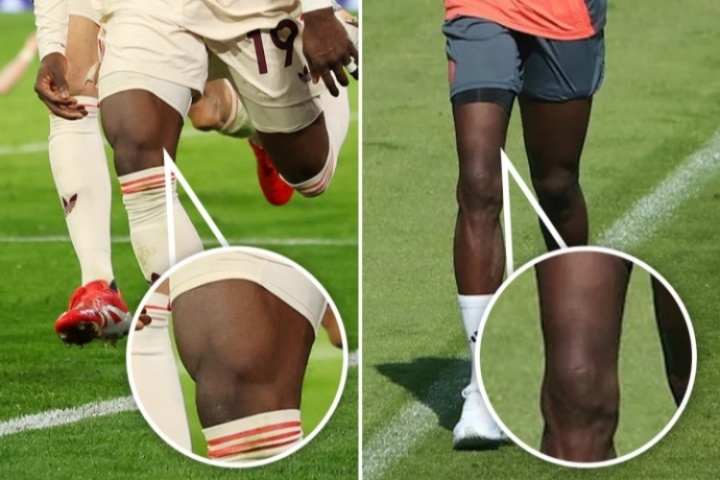 阿方索-戴维斯重伤5个月归来，右大腿肌肉明显流失比小腿还细